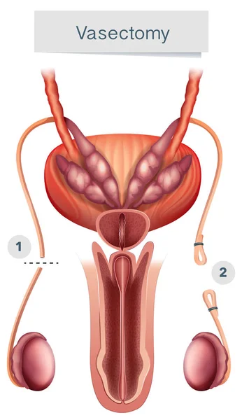 Anatomie humaine de la vasectomie sur fond blanc — Image vectorielle