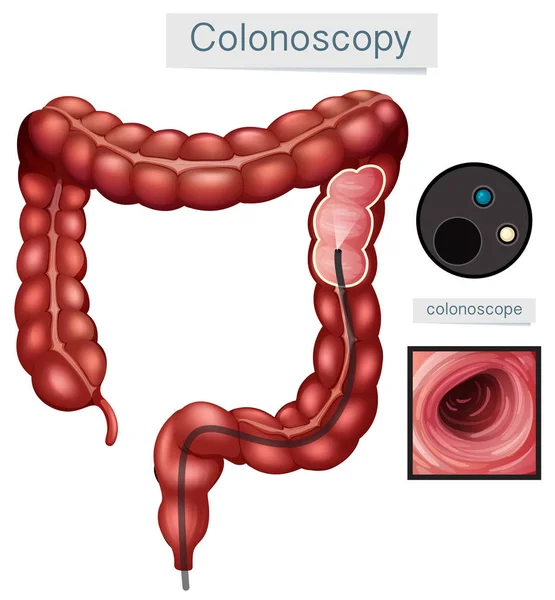 Colonoscopia de anatomía humana sobre fondo blanco — Archivo Imágenes Vectoriales