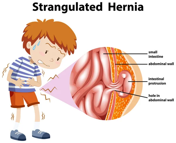 Menino com hérnia estrangulada no diagrama — Vetor de Stock