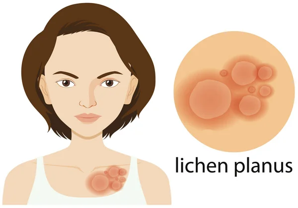 Diagram showing lichen planus on woman skin — Stock Vector
