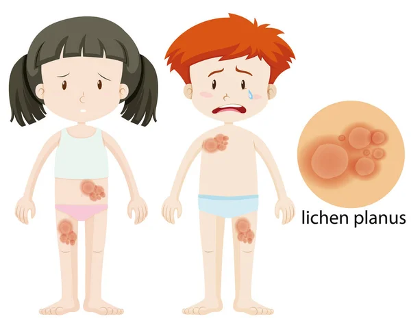 男の子と女の子とともにlichen planus — ストックベクタ