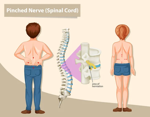 Diagrama mostrando nervo comprimido em humanos — Vetor de Stock