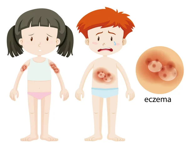 Diagrama mostrando crianças com eczema — Vetor de Stock