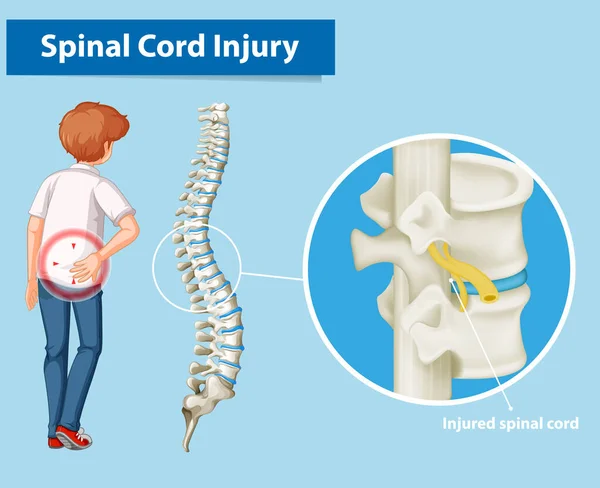 Diagram showing spinal cord injury — ストックベクタ