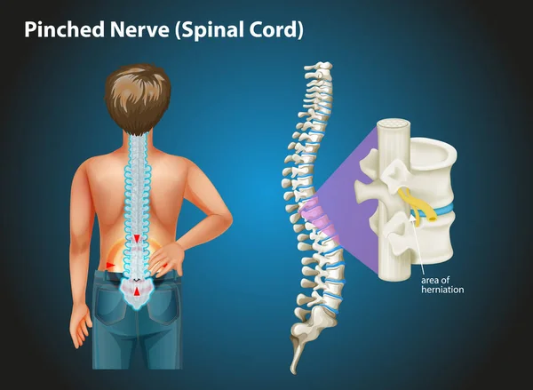 Diagrama mostrando nervo comprimido em humanos — Vetor de Stock