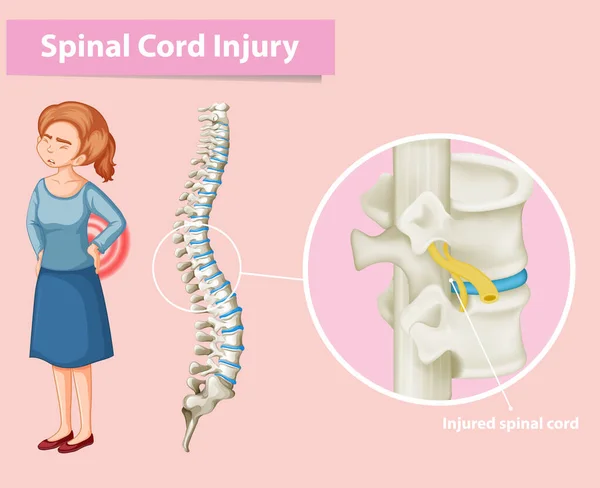 Diagram som visar ryggmärgsskada hos människa — Stock vektor