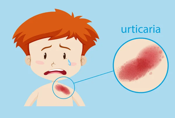 Diagram showing boy with urticaria — Stock Vector