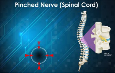 Sinir sıkışması gösteren diyagram 