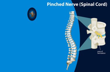 Sinir sıkışması gösteren diyagram