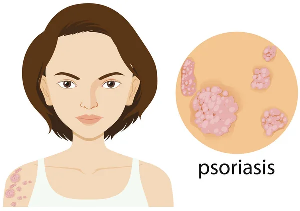 Mujer con psoriasis en póster — Vector de stock