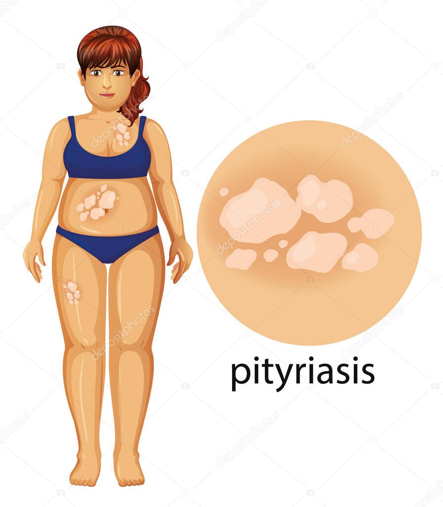 Woman with pityriasis on white background
