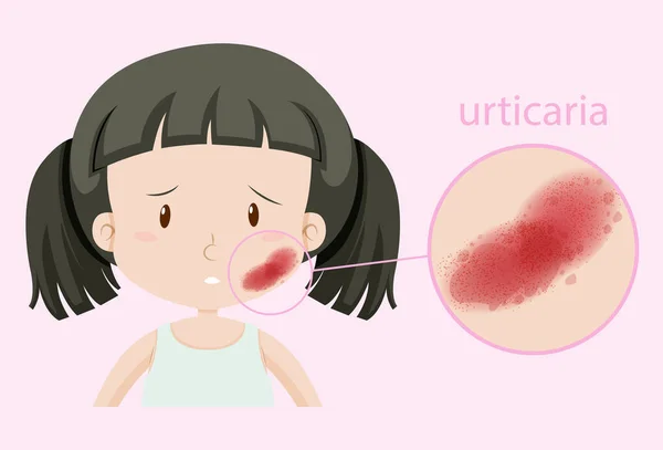 Meisje met urticaria op haar gezicht — Stockvector
