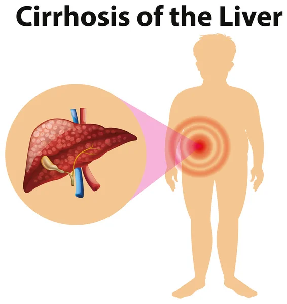 Diagram showing cirhosis of the liver — ストックベクタ