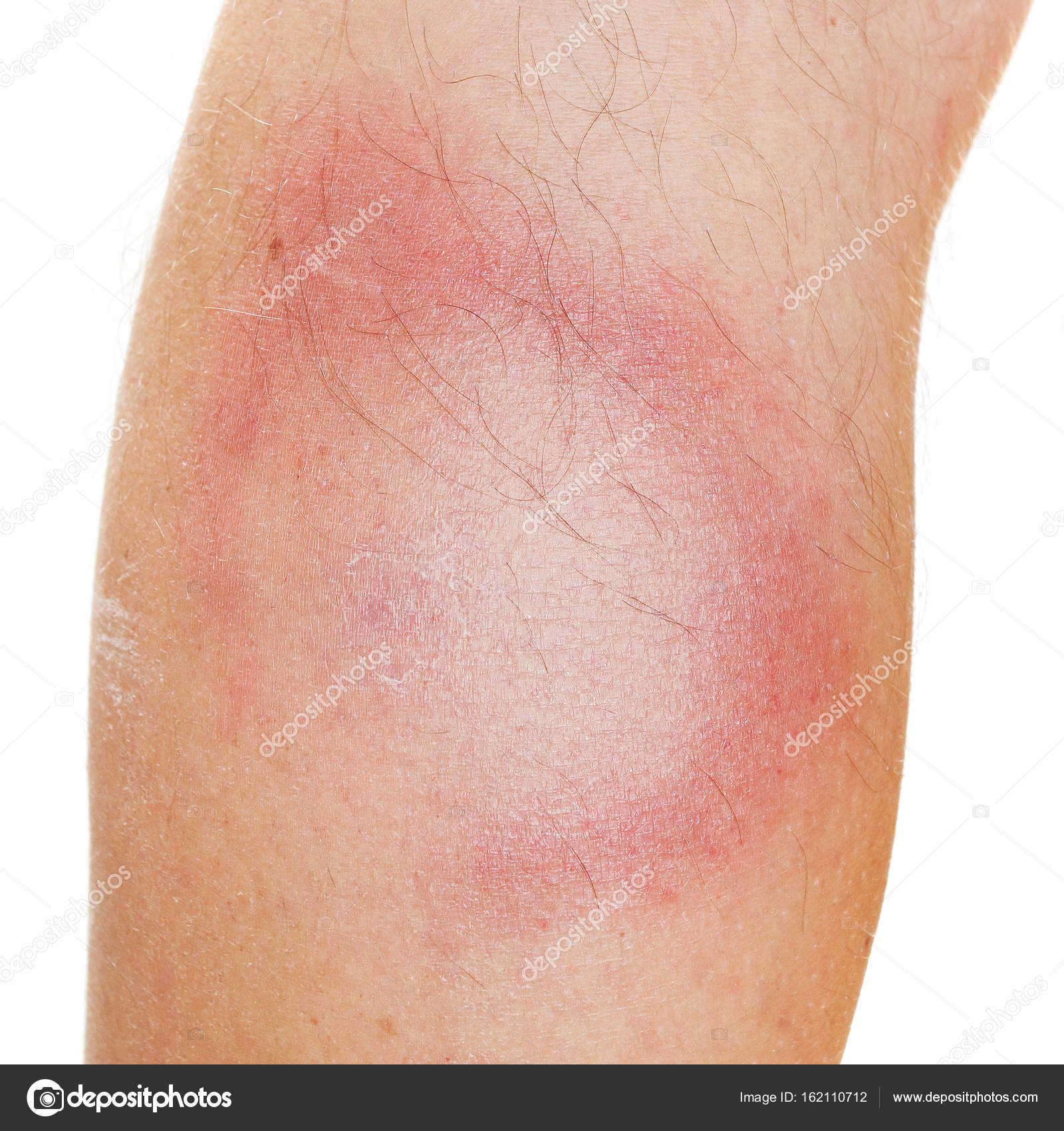 Een Erythema Migrans uitslag, vroege fase van de ziekte ...