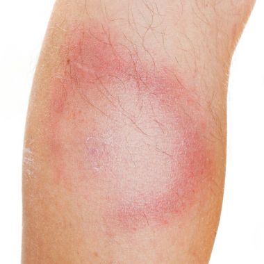 Bir Eritema Migrans döküntü, erken aşamada Lyme hastalığı.