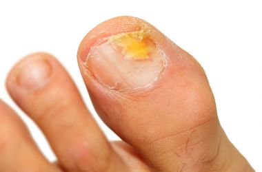 Onychomycosis fungal infection of the nail. clipart