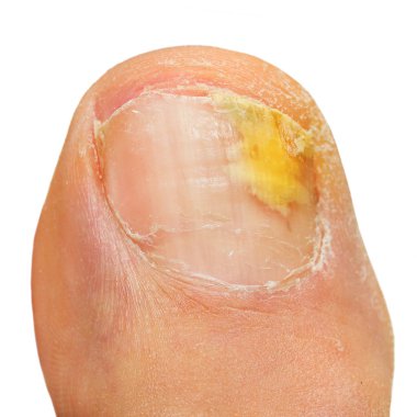 Onychomycosis fungal infection of the nail. clipart