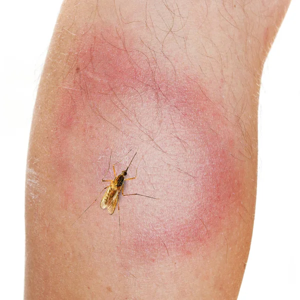 Mosquito and An Erythema Migrans rash. — Stock Photo, Image