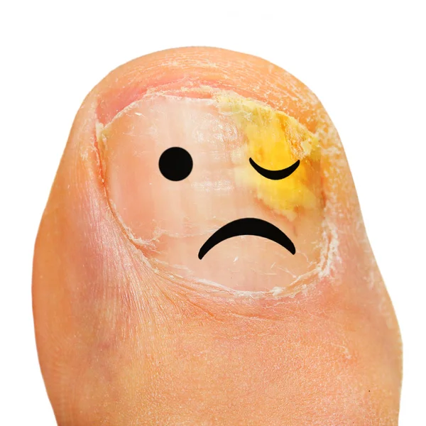 Onychomycosis fungal infection of the nail. — Stock Photo, Image