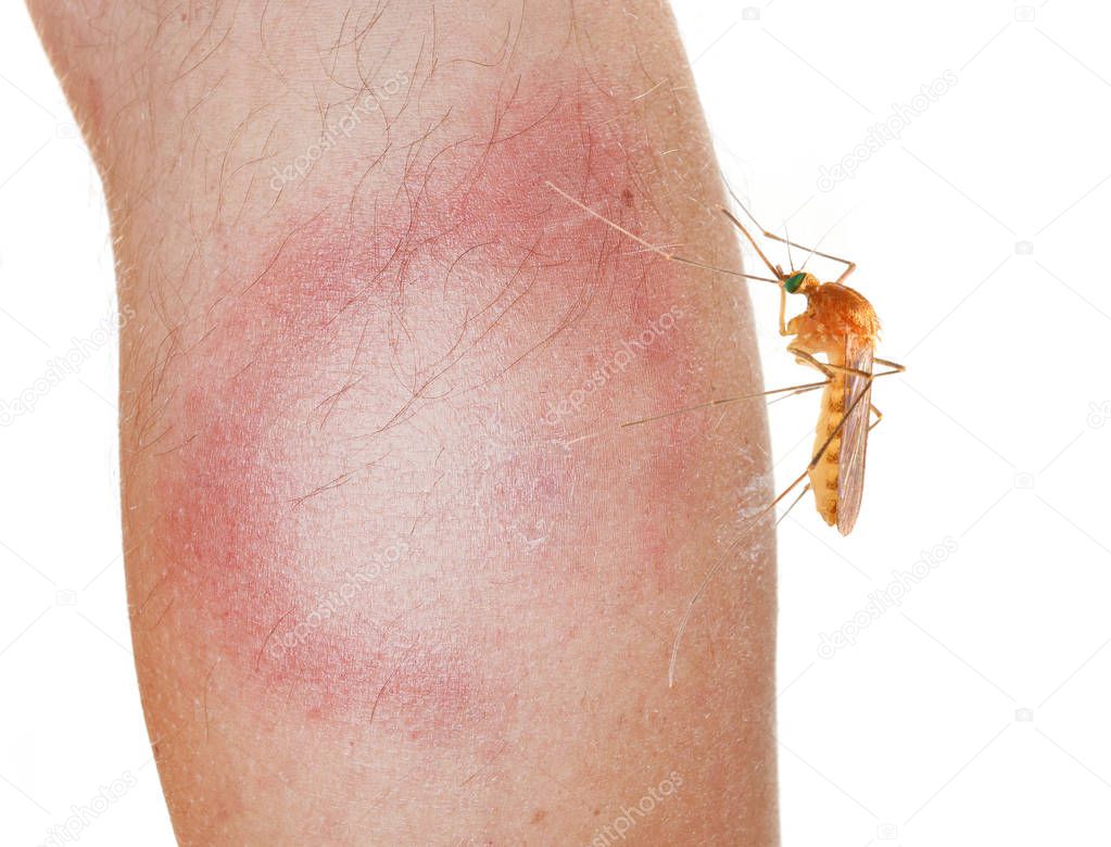 Mosquito and An Erythema Migrans rash.