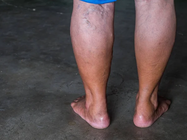 The varicose veins on a legs — Stock Photo, Image