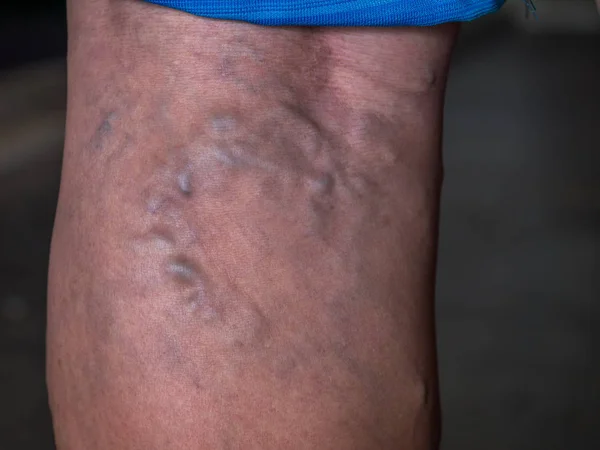 Primer plano de las venas varicosas en una pierna — Foto de Stock