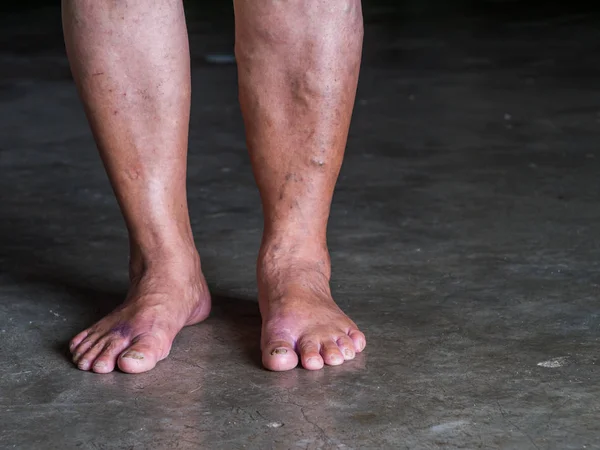 Varicose Veins Legs Old Woman — Stock Photo, Image