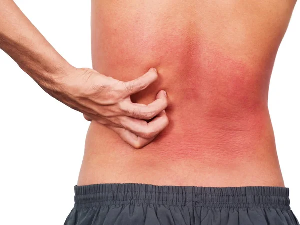 Hand man zijn allergie huid krabben op rug — Stockfoto