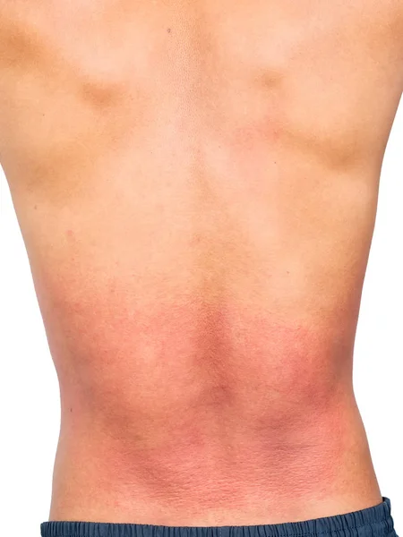 Skin allergy on back of man — Stock Photo, Image