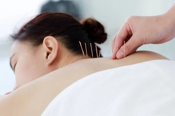Doktorun eli akupunktur terapisi yapıyor. Asyalı kadın ve — Stok fotoğraf