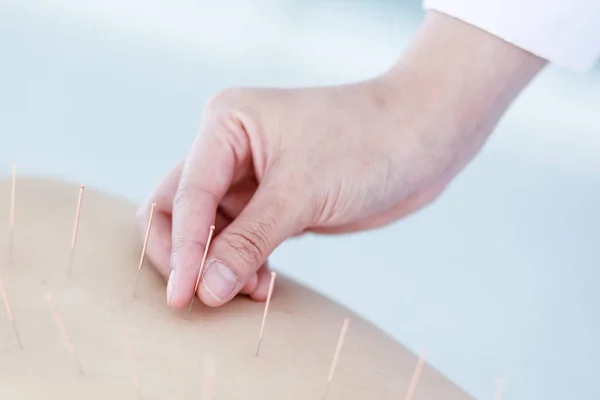 Ręka lekarza wykonującego terapię akupunkturą. Azjatki i — Zdjęcie stockowe