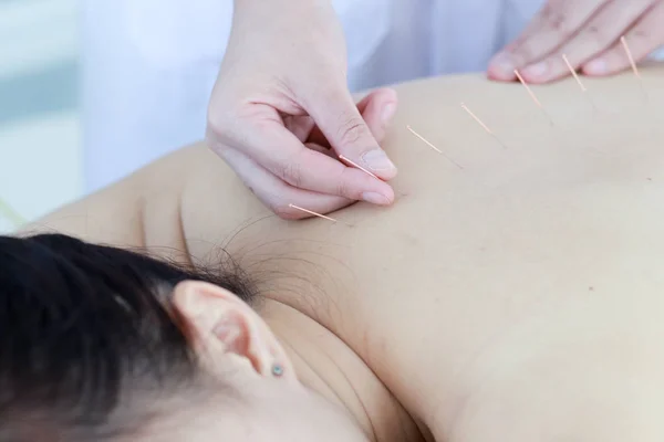 hand of doctor performing acupuncture therapy . Asian female und