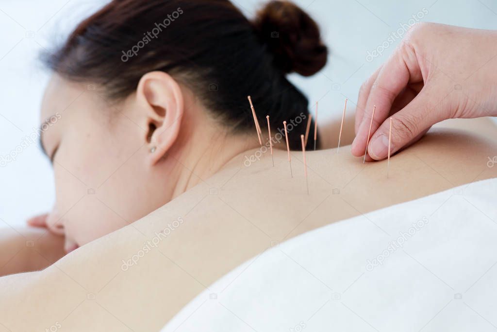 hand of doctor performing acupuncture therapy . Asian female und