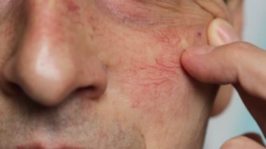 Adamın yüzü, damar yıldızları ve çift taraflı deri. Ciltteki kılcal damarların, telangiectasiaların yakın görüntüsü