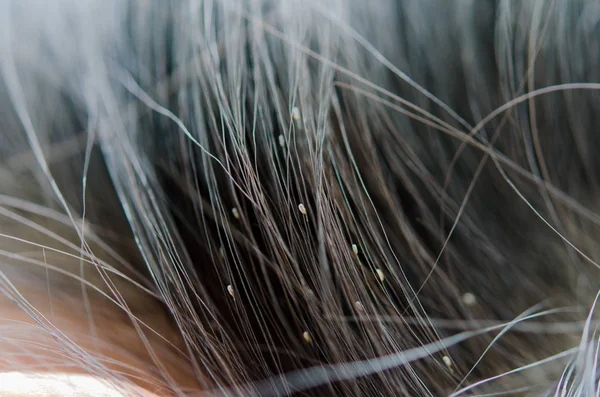 Lice on the hair — Stock Photo, Image