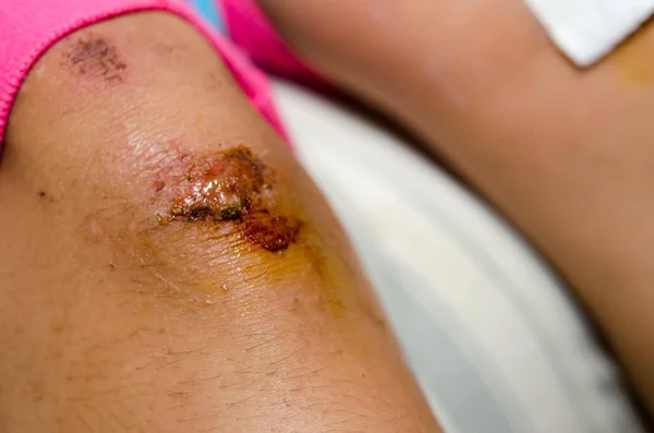 Wound falls to the knee — Stock Photo, Image