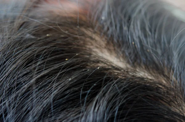 Piojos en el cabello — Foto de Stock