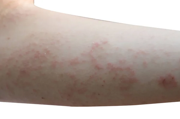 Red rash on the arms — Stock Photo, Image