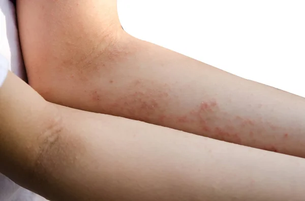 Red rash on the arms — Stock Photo, Image