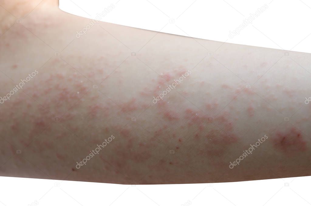 red rash on the arms