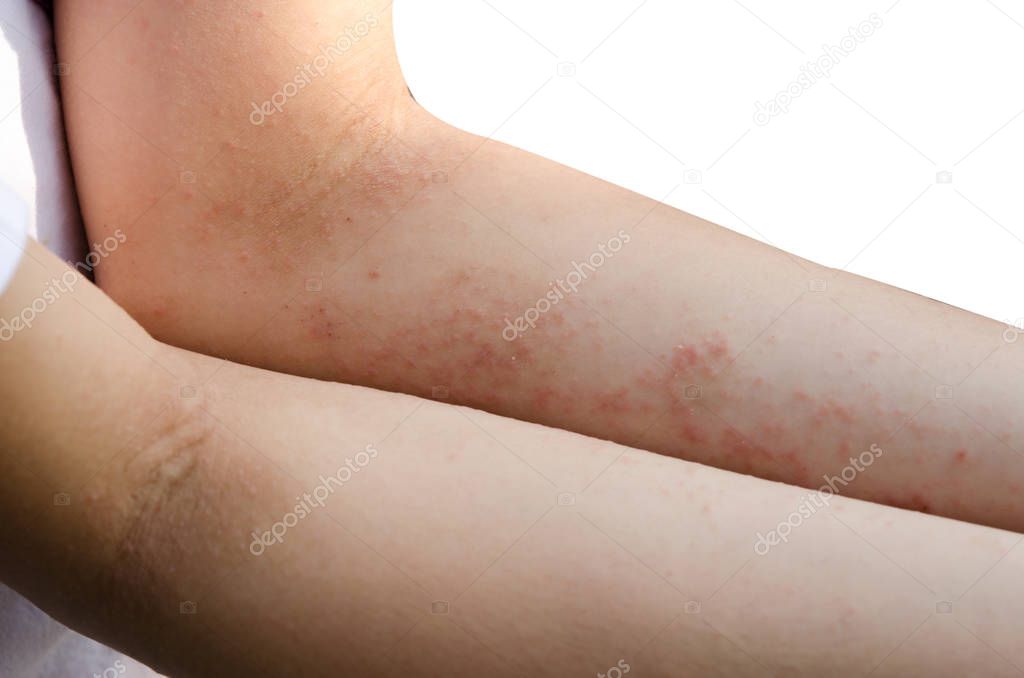 red rash on the arms