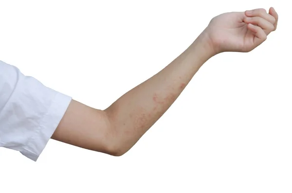 Red rash on the arms — Stock Photo, Image