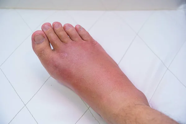 Zblízka Starý Muž Pravá Noha Kotník Zranění Čekání Otoky Infekční — Stock fotografie