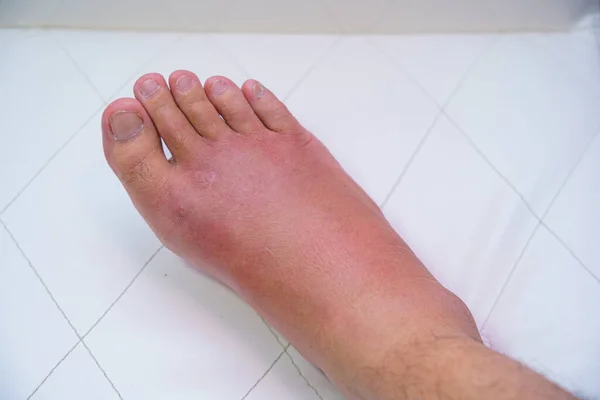Sağ ayağı kapat, ayak bileği yaralı, bekliyor ve bulaşıcı hastalıkları şişiriyor. Arı sokması, alerjik reaksiyonlar. Beyaz arka planda kanlı ve tuzlu bir hastanın yarasını sarmak için hemşire tedavisi..