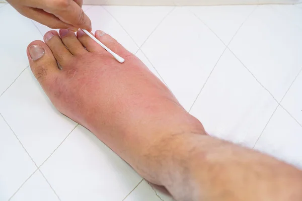 Sağ ayağı kapat, ayak bileği yaralı, bekliyor ve bulaşıcı hastalıkları şişiriyor. Arı sokması, alerjik reaksiyonlar. Beyaz arka planda kanlı ve tuzlu bir hastanın yarasını sarmak için hemşire tedavisi..
