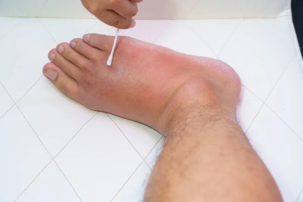 Sağ ayağı kapat, ayak bileği yaralı, bekliyor ve bulaşıcı hastalıkları şişiriyor. Arı sokması, alerjik reaksiyonlar. Beyaz arka planda kanlı ve tuzlu bir hastanın yarasını sarmak için hemşire tedavisi..