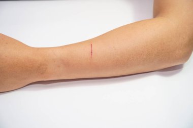 Yaşlı adamların kollarını, üst uzuvlarını ya da kollarını yaralılara kapatın. Bekleyenlere, kan ve lezyona. Hemşirelik tedavisi için kesik..