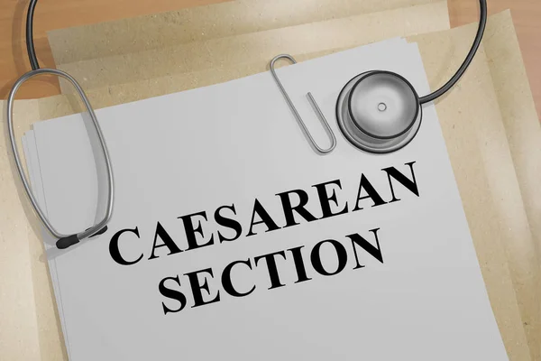 Caesarean Section - konsep medis — Stok Foto
