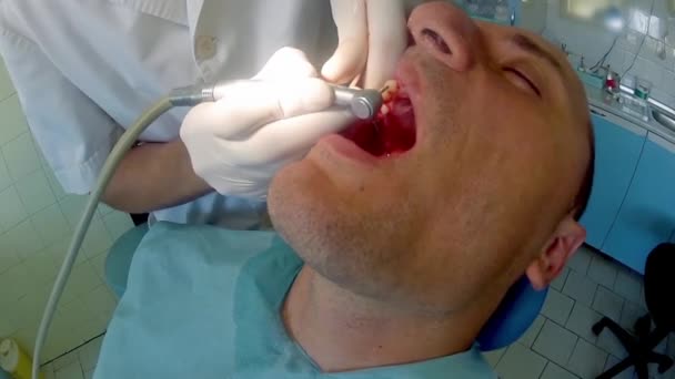 Tandarts Het Werk Tanden Van Volwassen Man Patiënt Voorbereiden Implantaat — Stockvideo