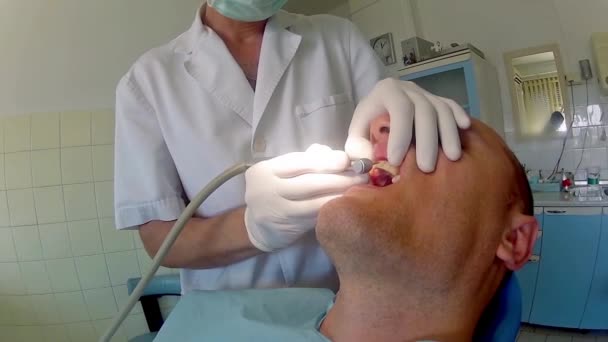 Tandarts Het Werk Tanden Van Volwassen Man Patiënt Voorbereiden Implantaat — Stockvideo